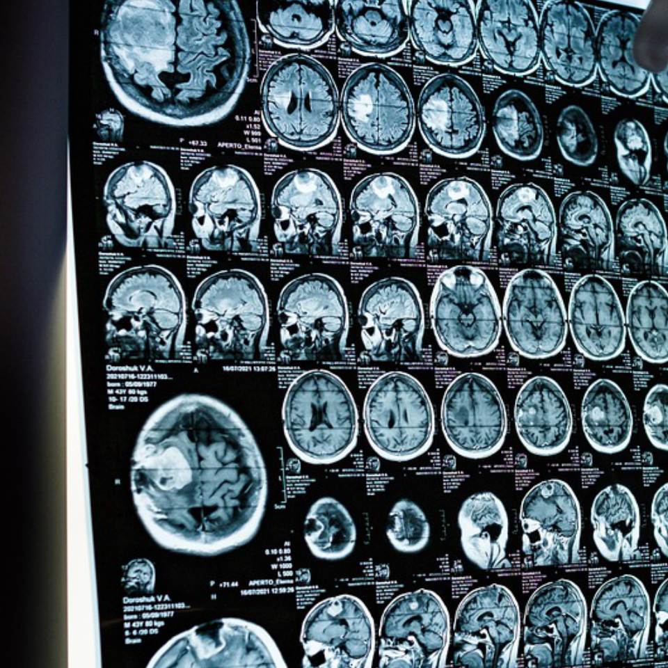 Glioblastoma detection